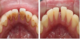 齦上/下潔治（洗牙）、齲齒充填（補牙）